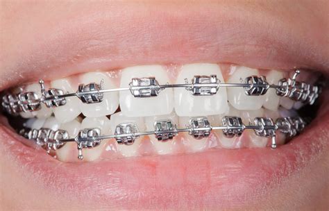 does maxicare cover dental braces|Reddit .